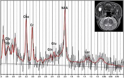 Early Changes in Glutamate Metabolism and Perfusion in Basal Ganglia following Hypoxia-Ischemia in Neonatal Piglets: A Multi-Sequence 3.0T MR Study